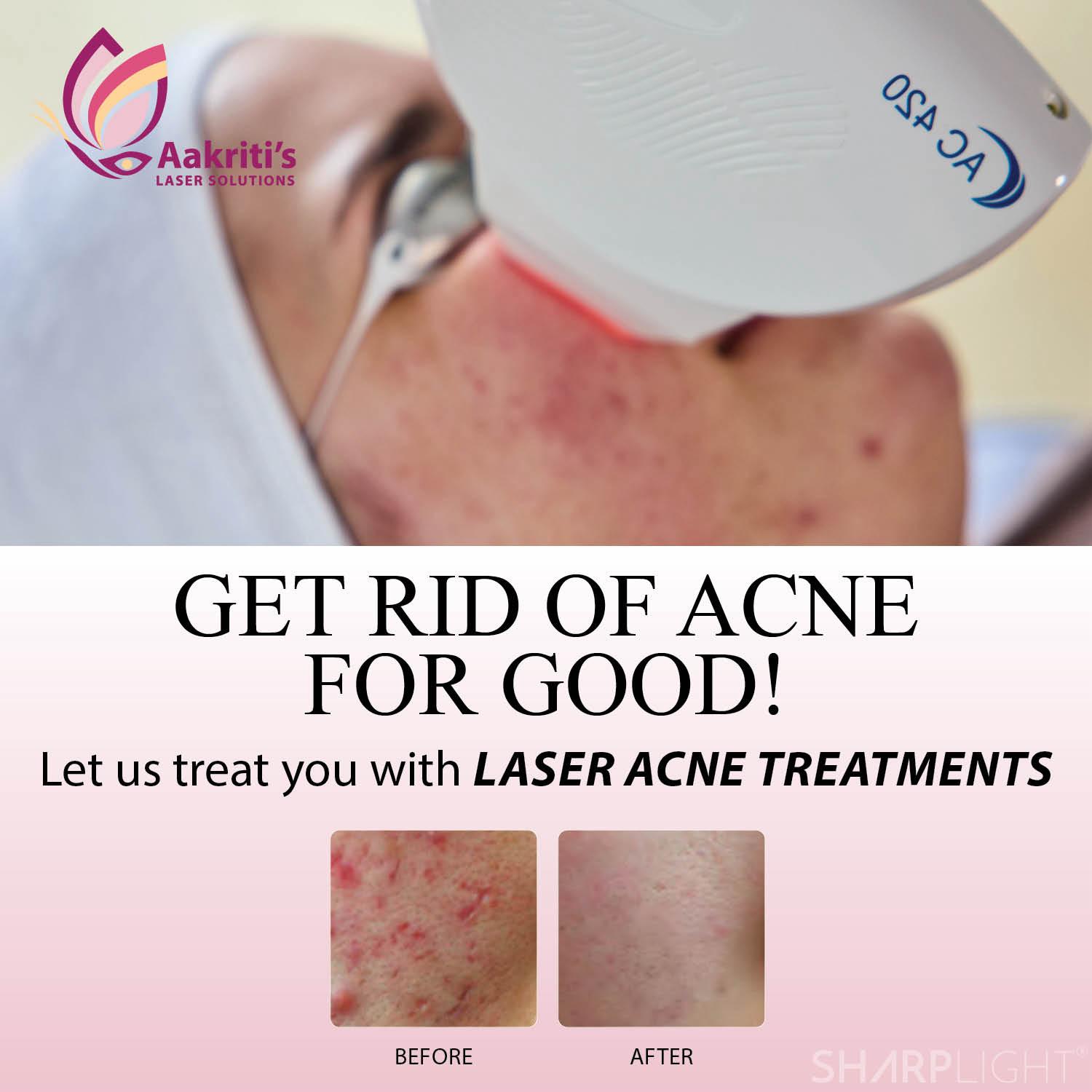 Facial Laser