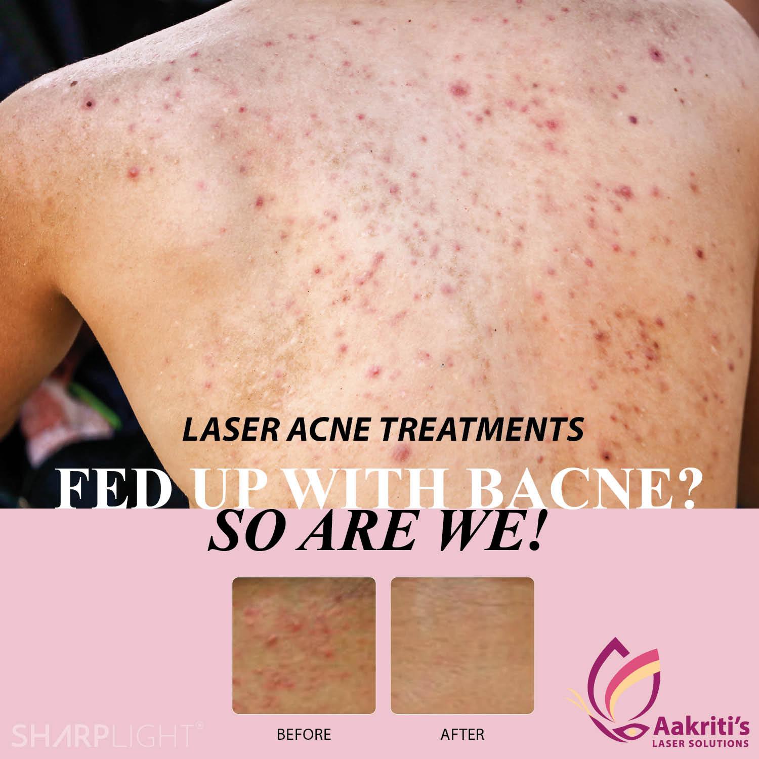 Facial Laser