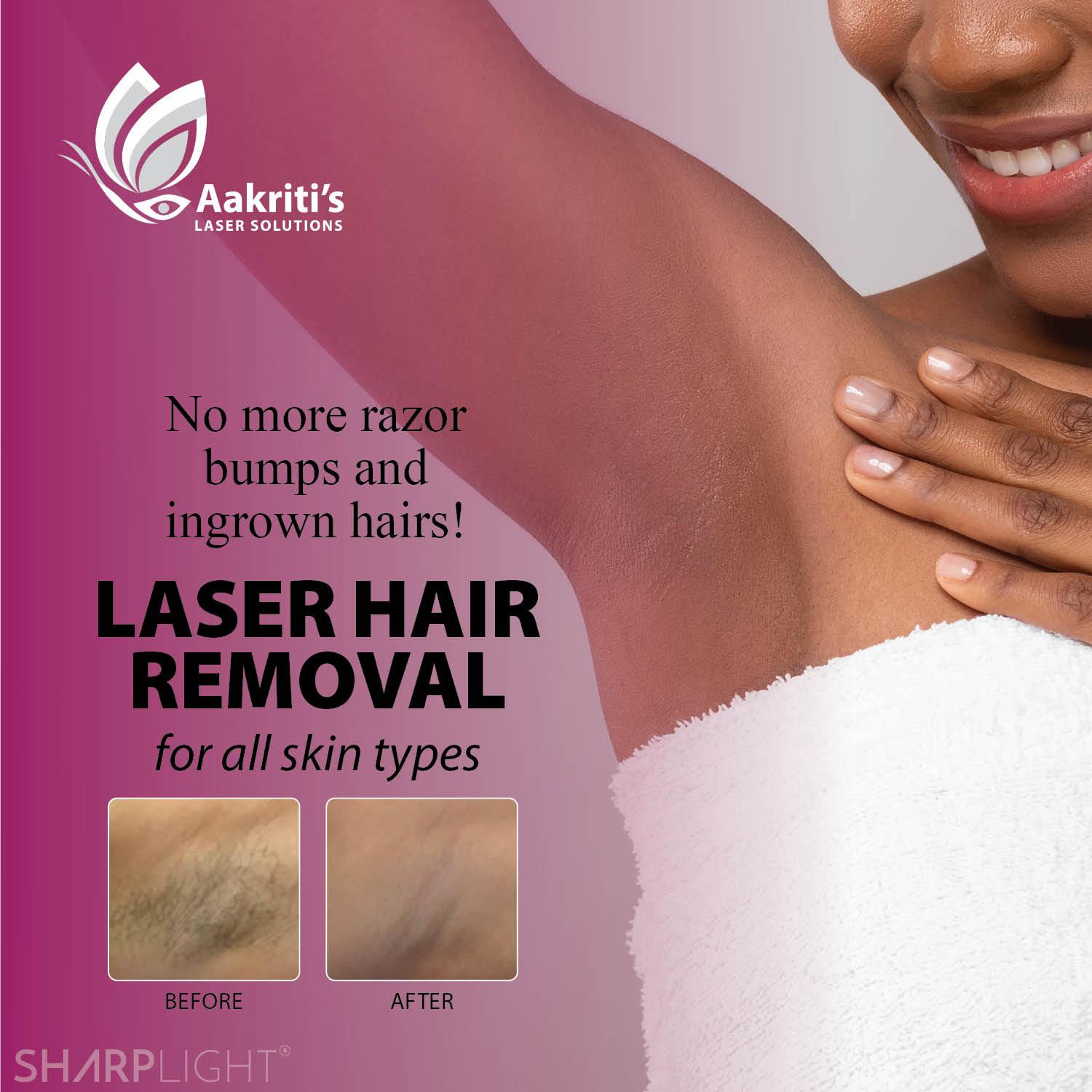 Facial Laser