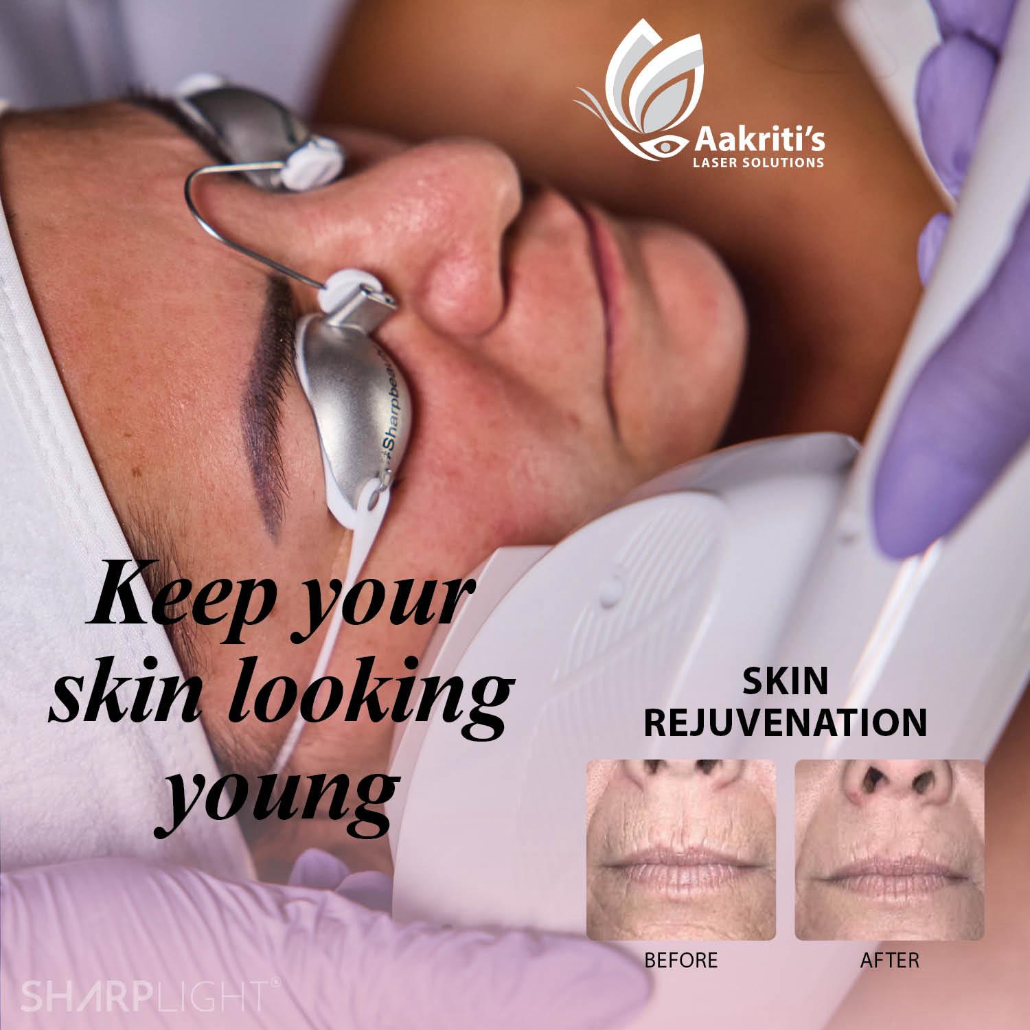 Facial Laser