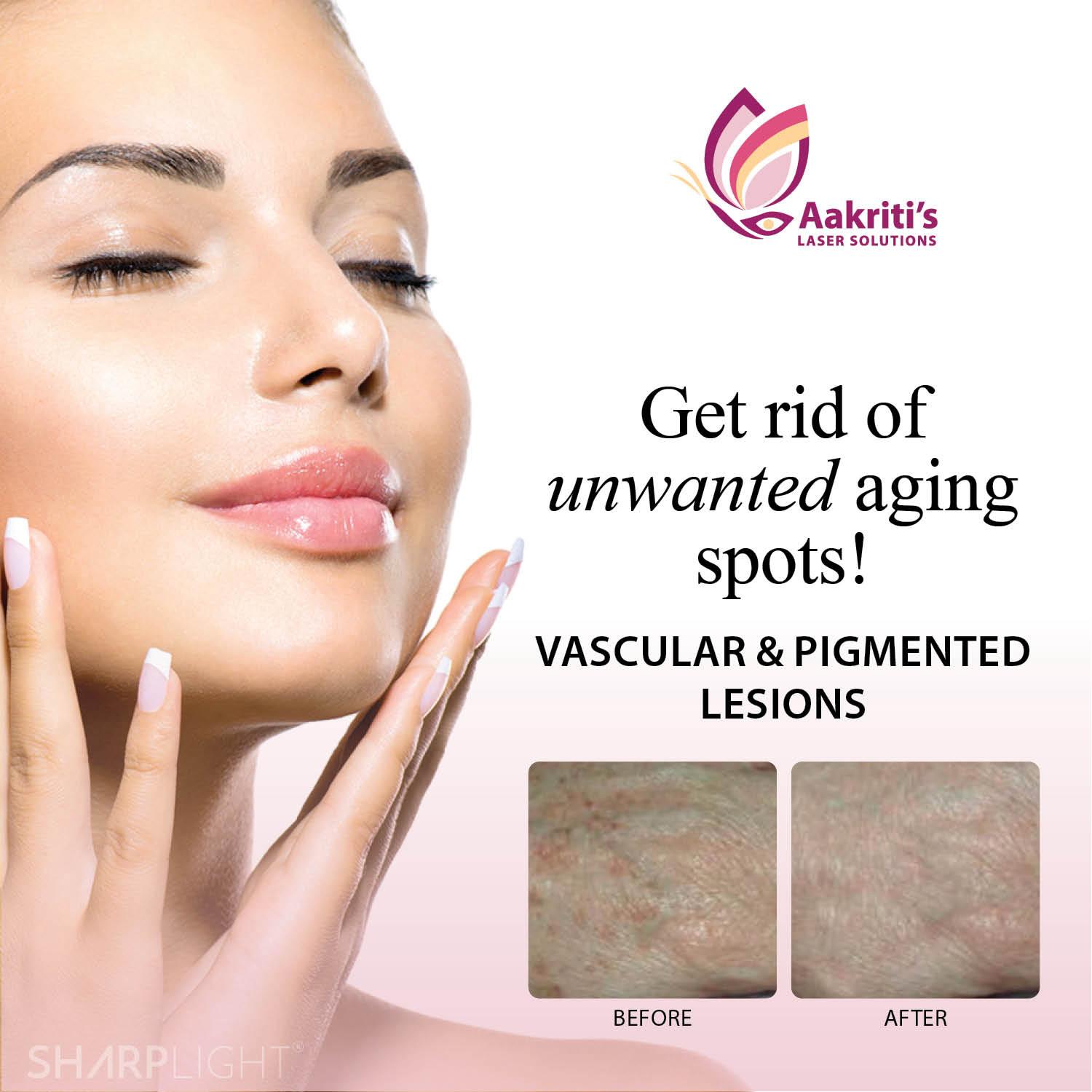 Facial Laser