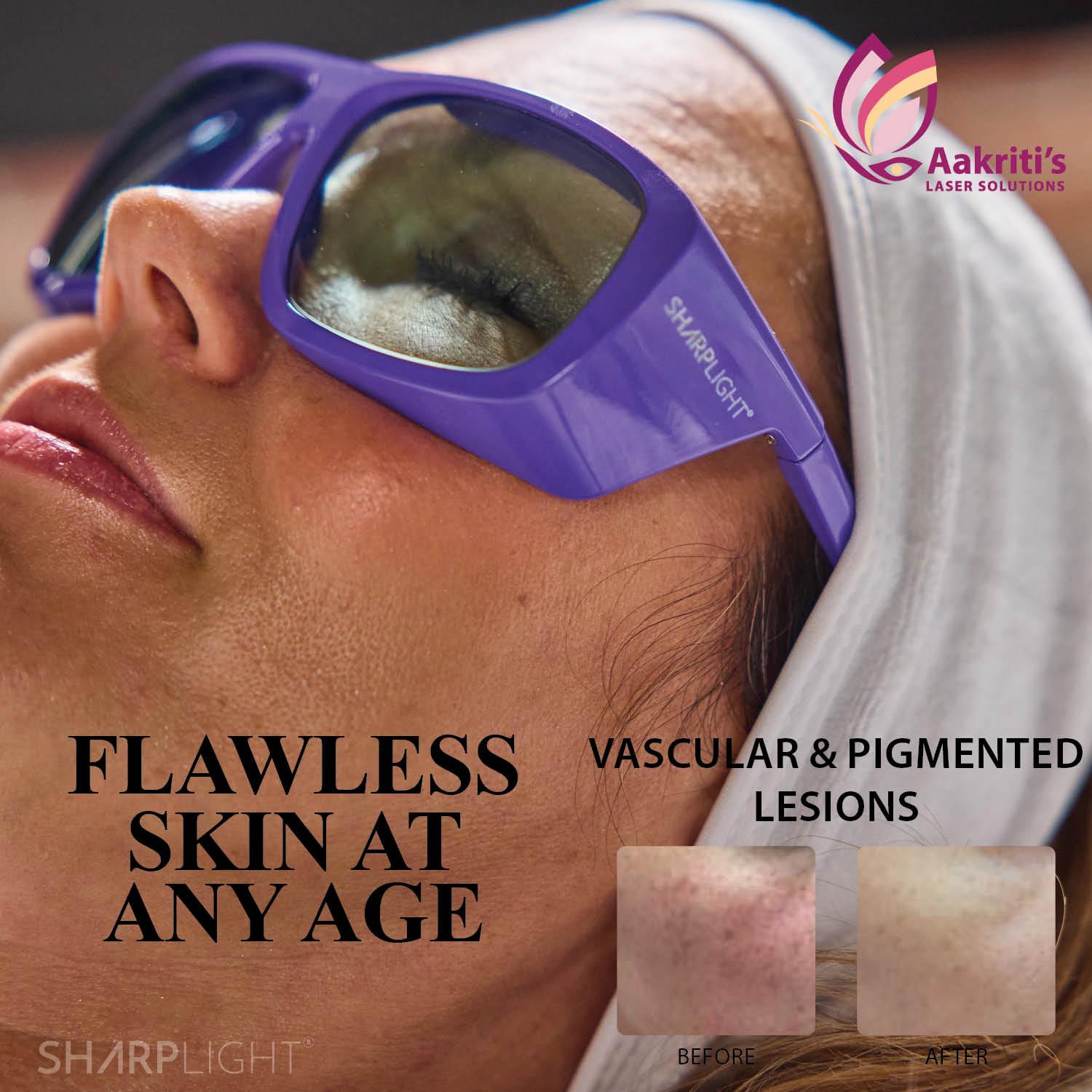 Facial Laser